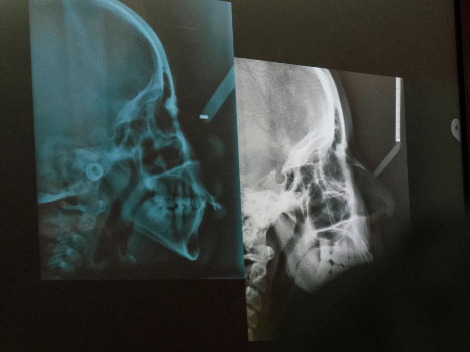 Téléradiographies de profil projetées à l'écran pour l'analyse céphalométrique