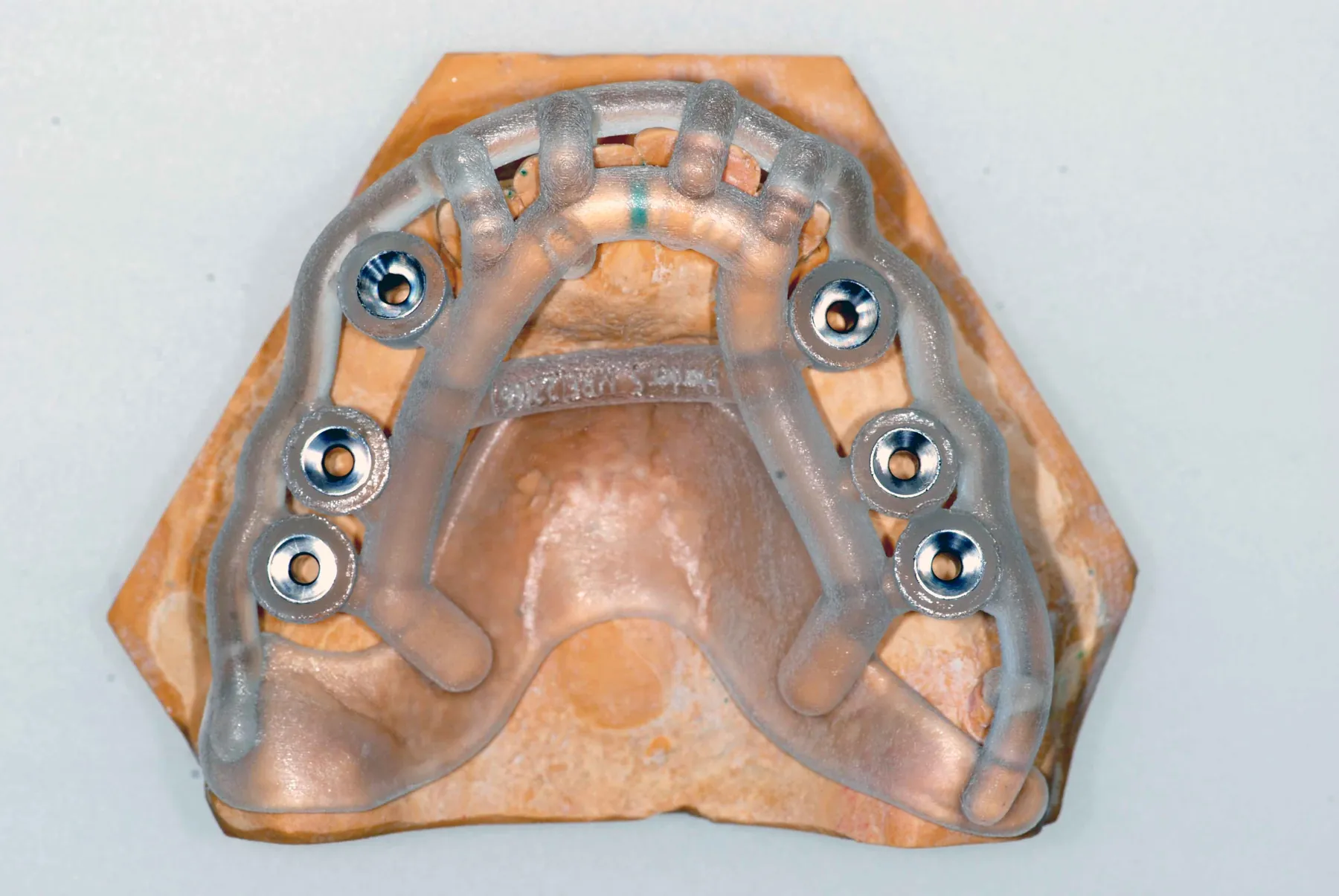 Guide de forage imprimé en 3D pour l'implantologie guidée, posé sur un modèle en plâtre