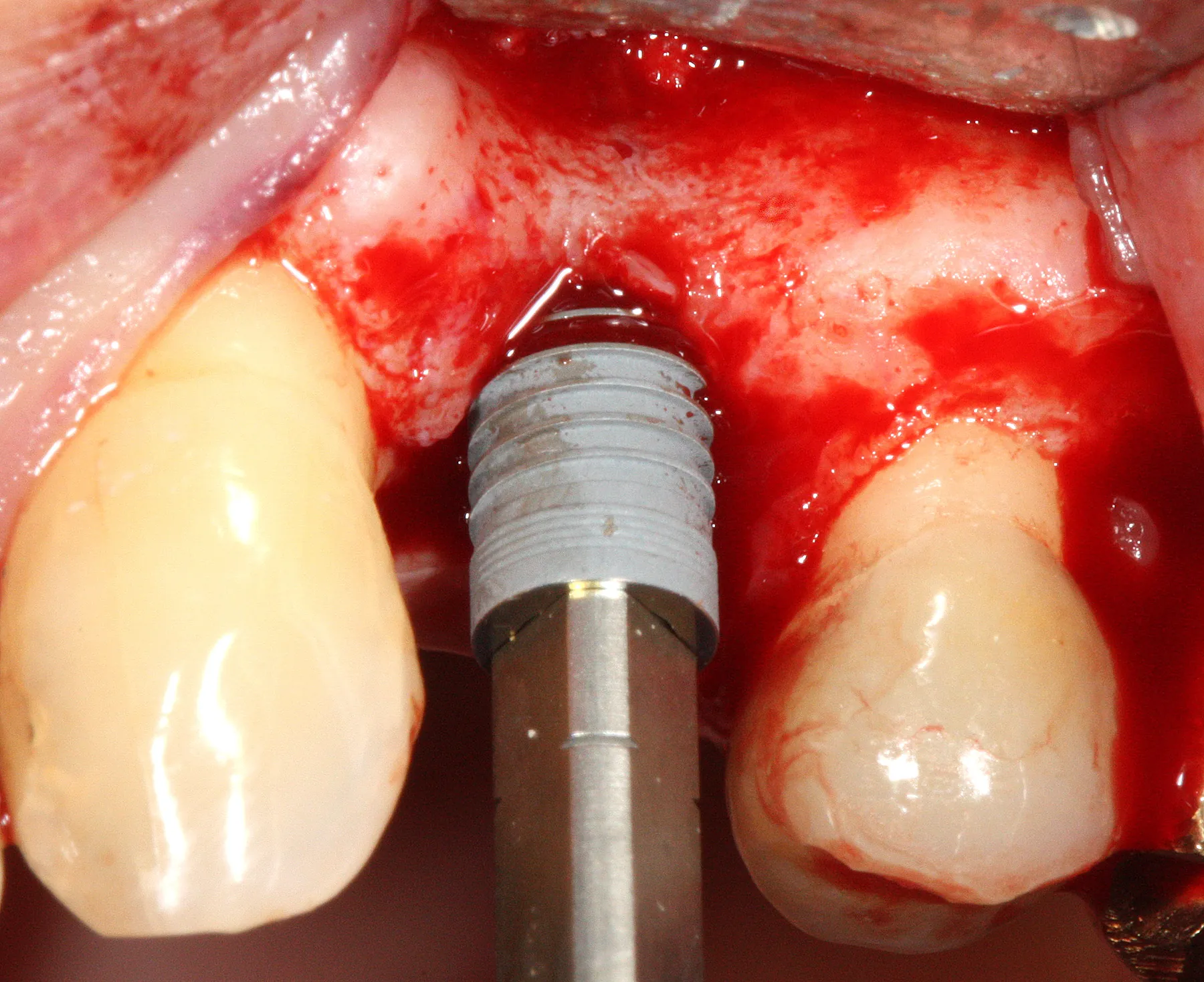 Vissage de l'implant dans l'ostéotomie avec le porte-implant