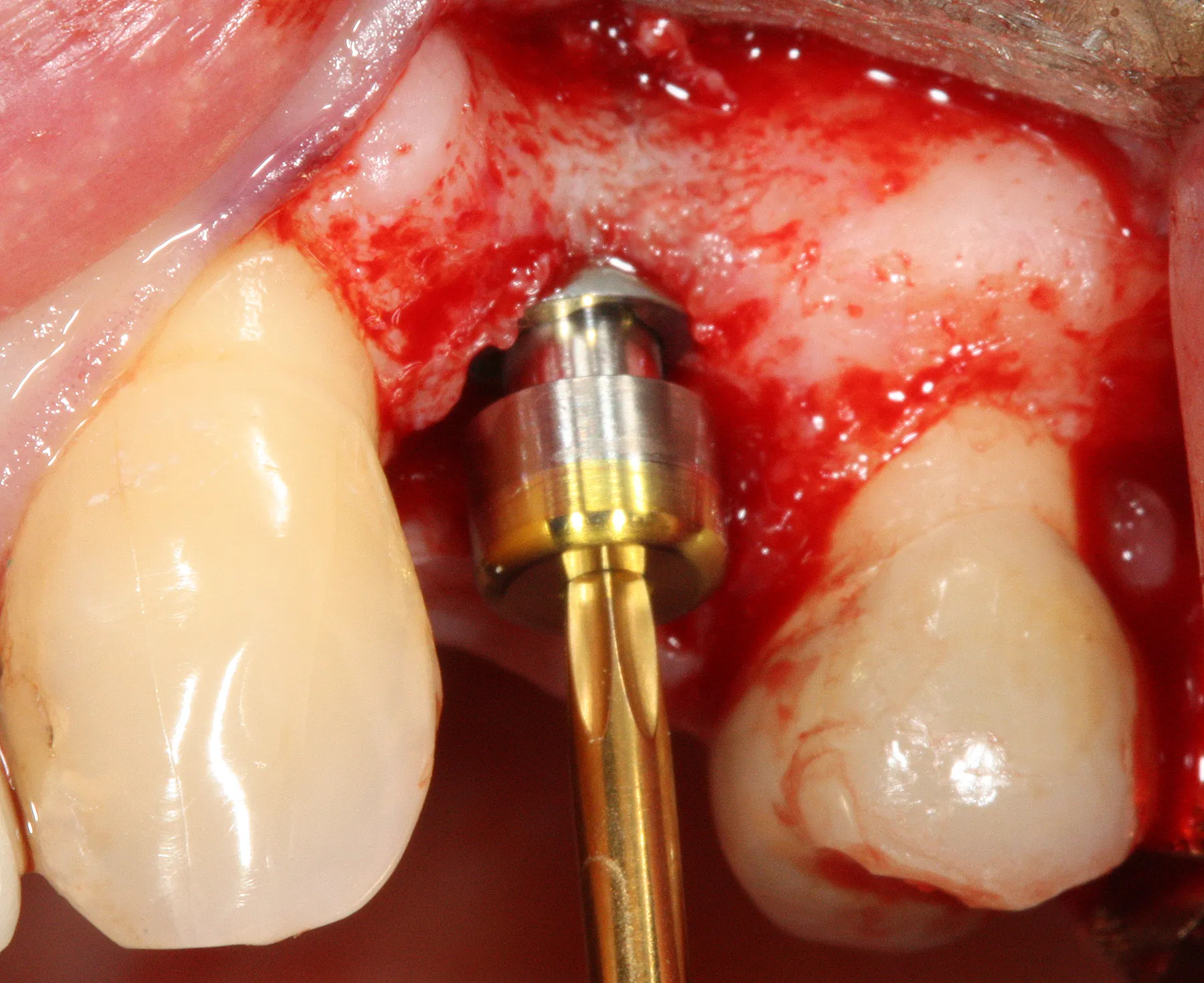 Mise en place de la vis de cicatrisation sur l'implant
