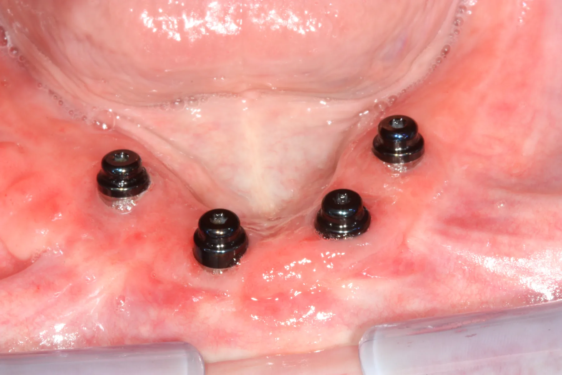 Quatre implants mandibulaires avec leurs piliers Novaloc, vue intra-orale